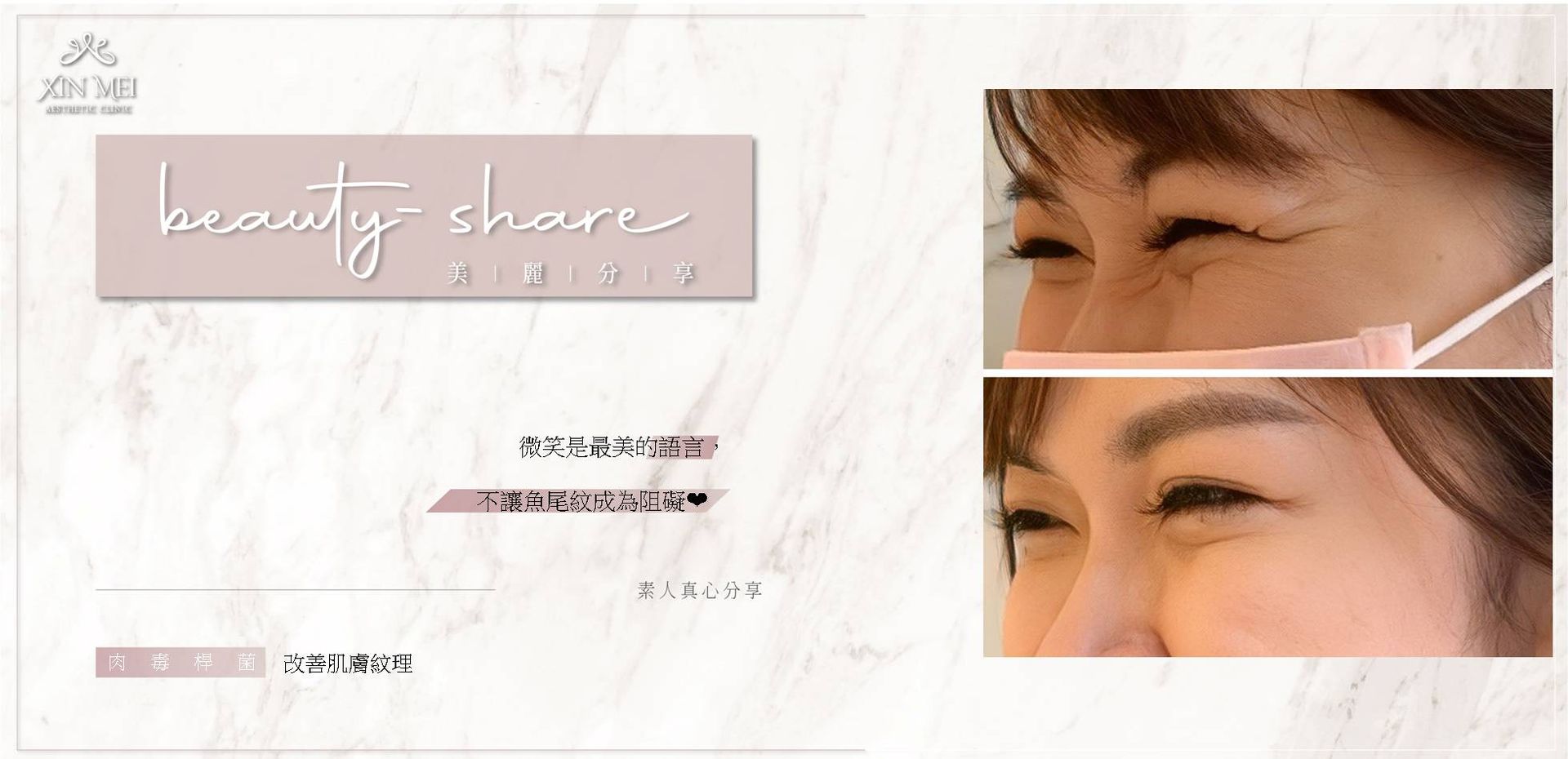 【分享】素人真心分享 ｜肉毒動態紋