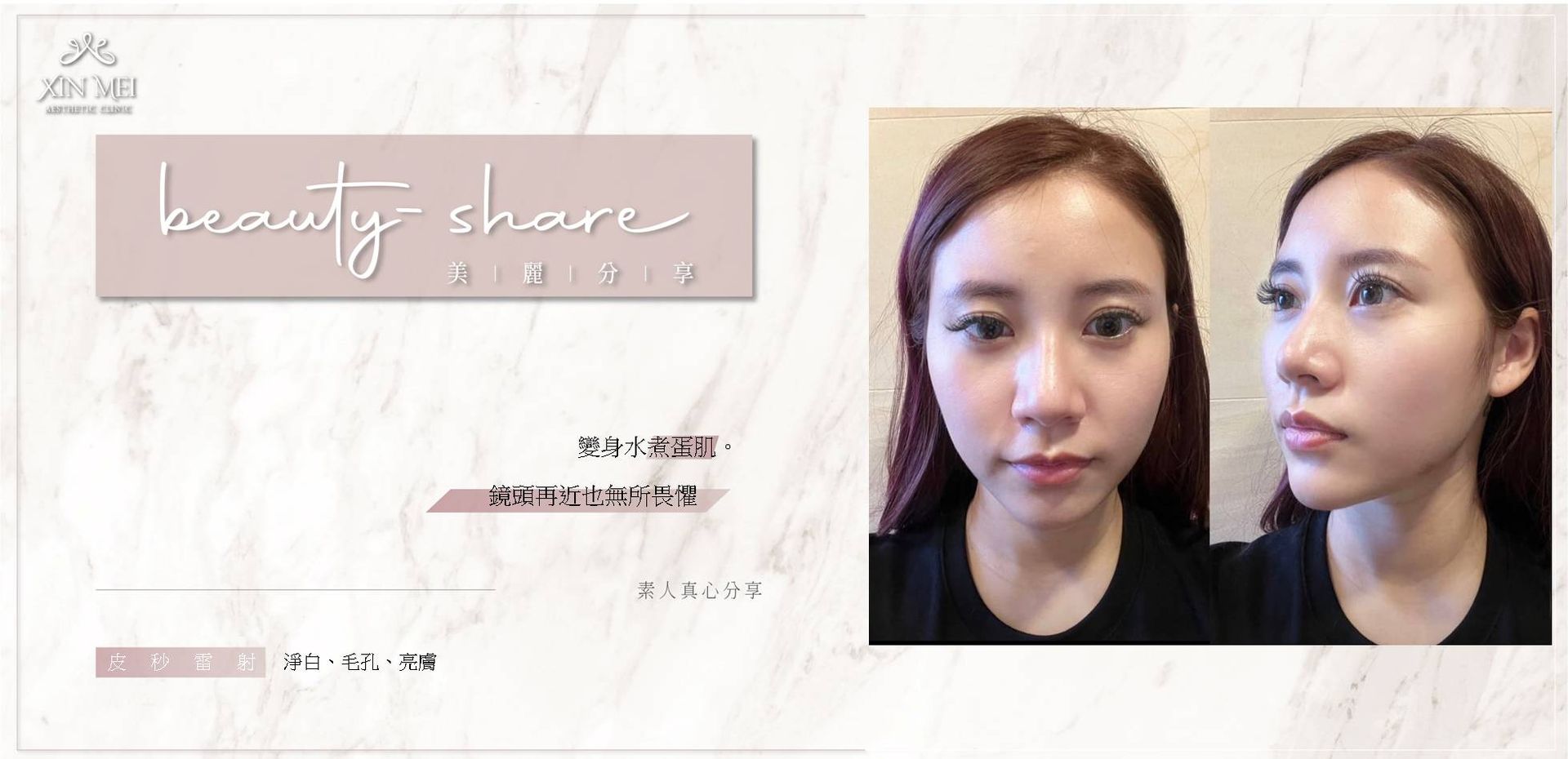 【分享】素人真心分享 ｜皮秒雷射