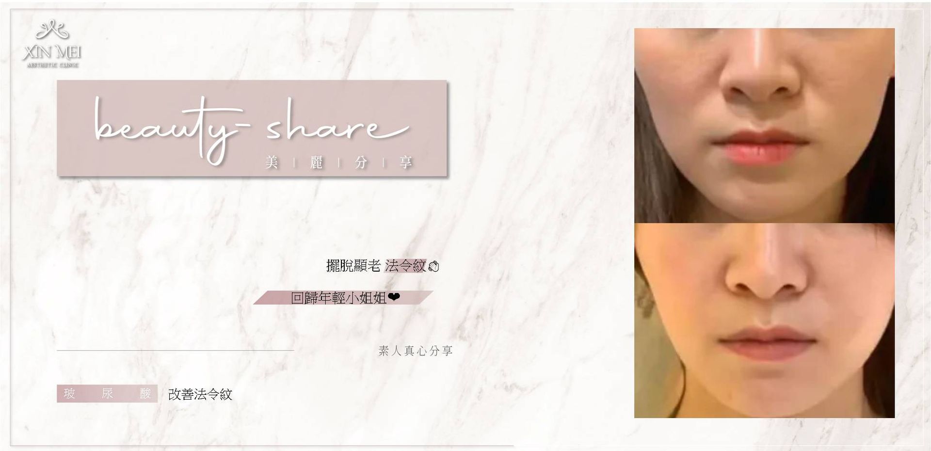 【分享】素人真心分享 ｜玻尿酸法令紋