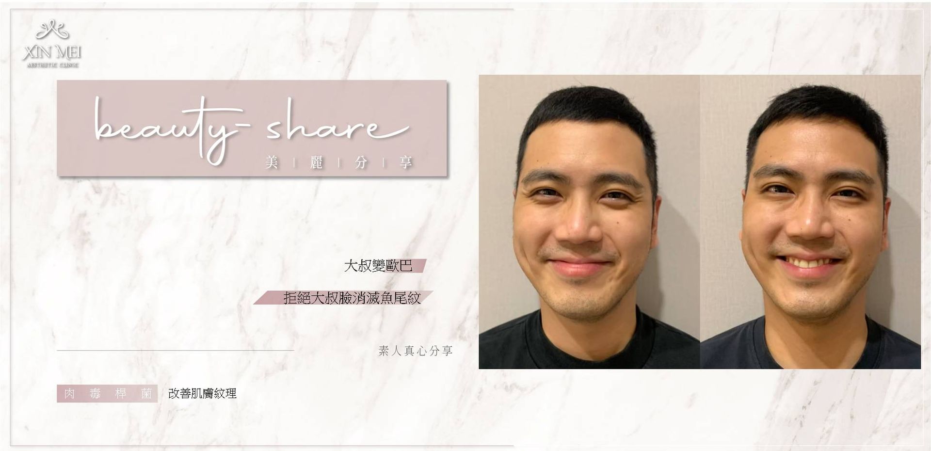 【分享】素人真心分享 ｜肉毒動態紋