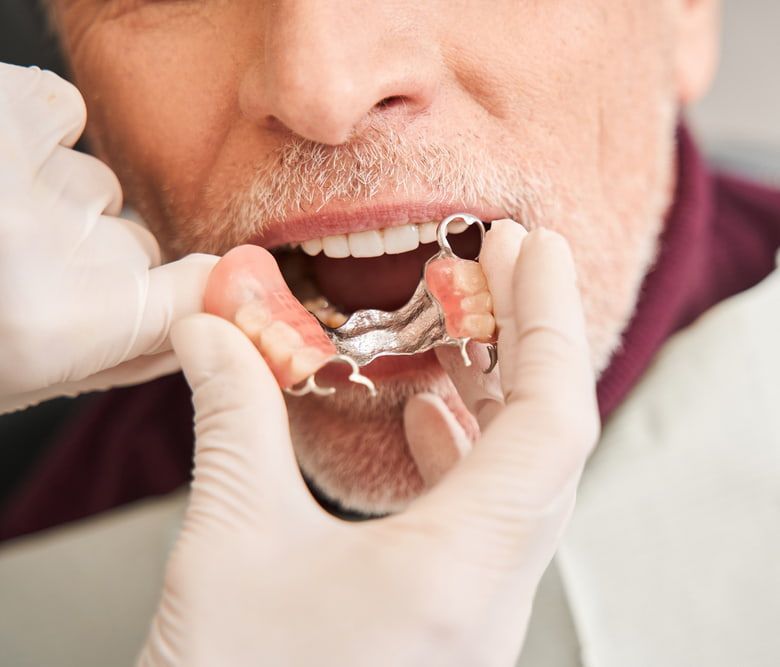 Trying a New Partial Denture - Dentures in the Blue Mountains, NSW