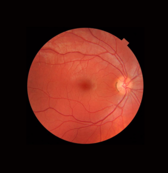 A Man is Looking at a Computer Screen With a Picture of His Eye on It — Michael Chu Optometrist in Cairns North, QLD