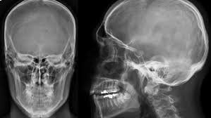 Radiografia teschio