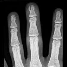 Radiografia mano