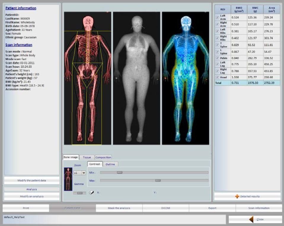 Risultato densitometria