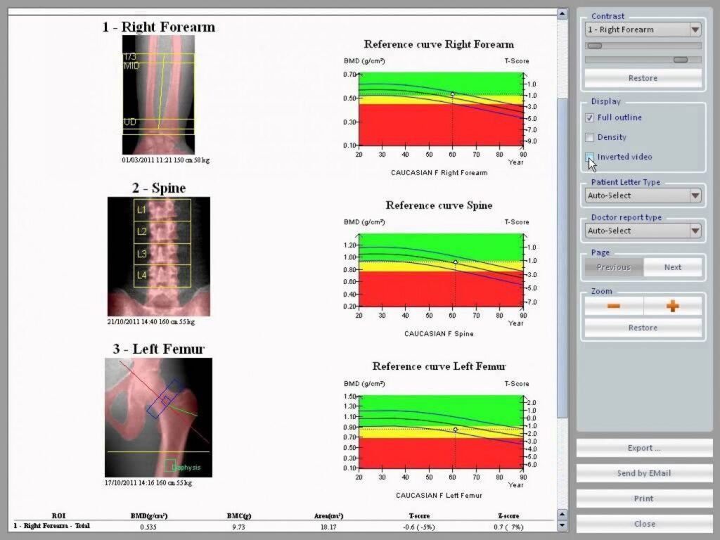 Risultato densitometria 2