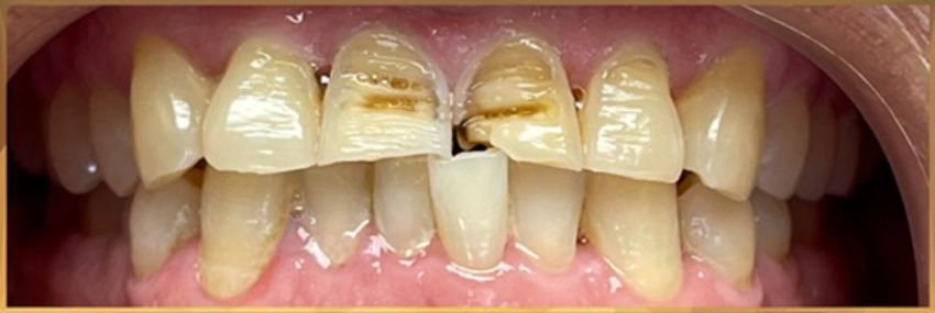 before crown implants