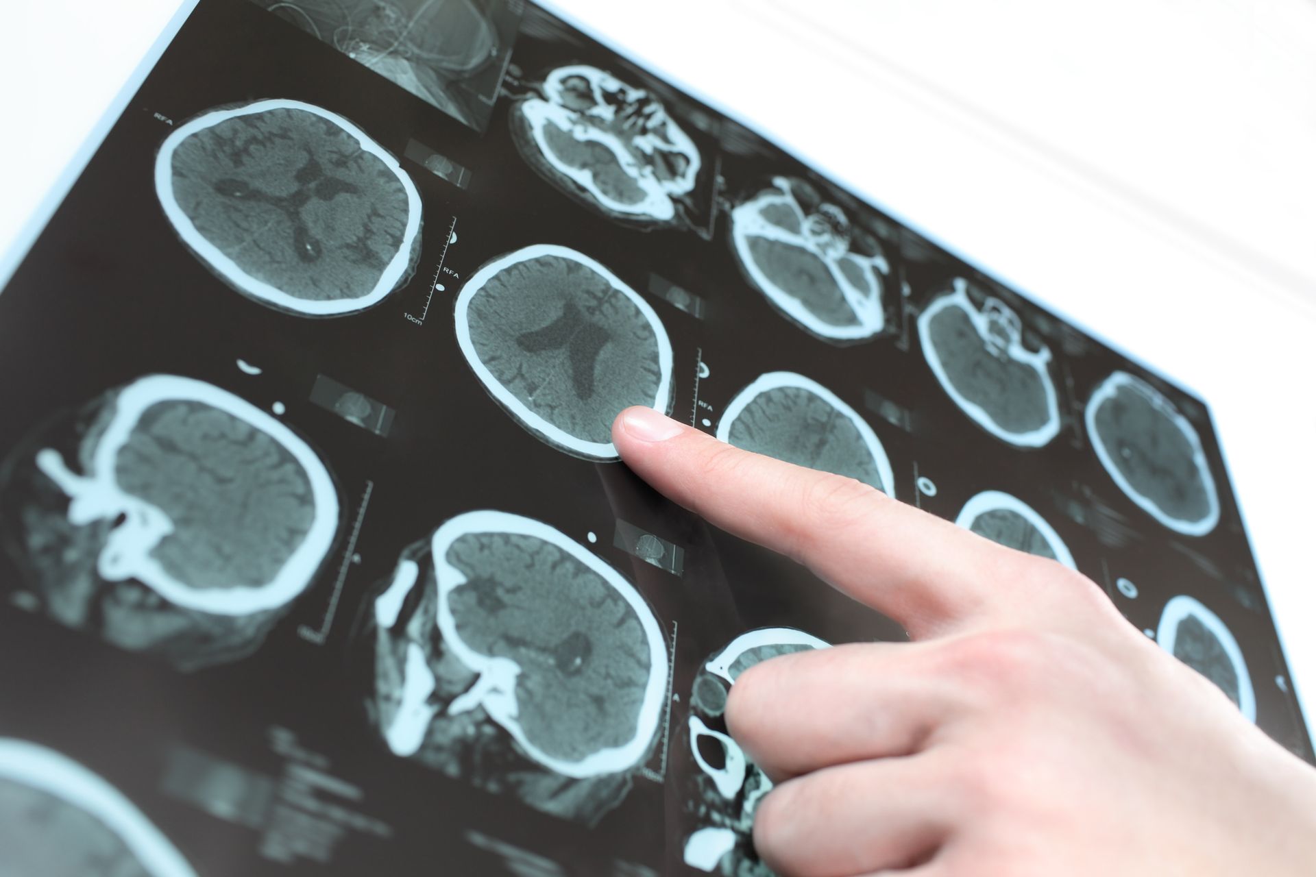 Person pointing at brain scan images on a lightbox.