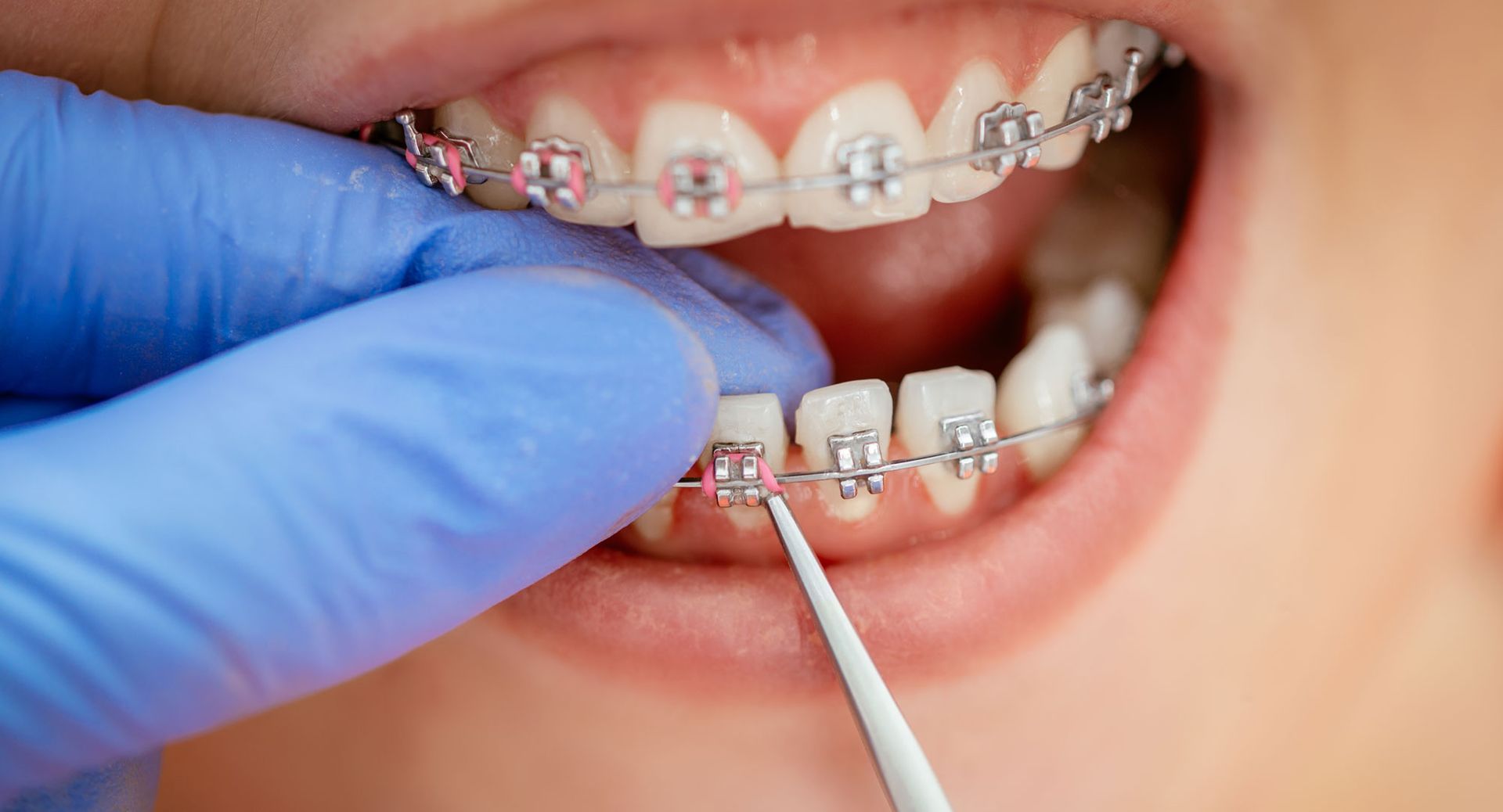 Cómo lavarte los dientes si tienes Brackets