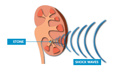 ESWL Diagram