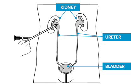 Percutaneous Nephrolithotomy (PCNL)