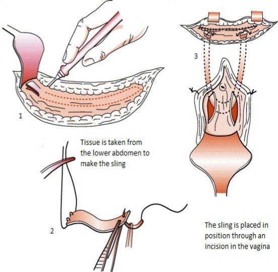 Rectus Fascial Sling