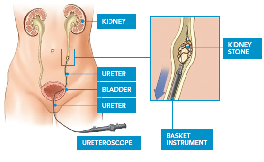 Ureteric Stone Diagram