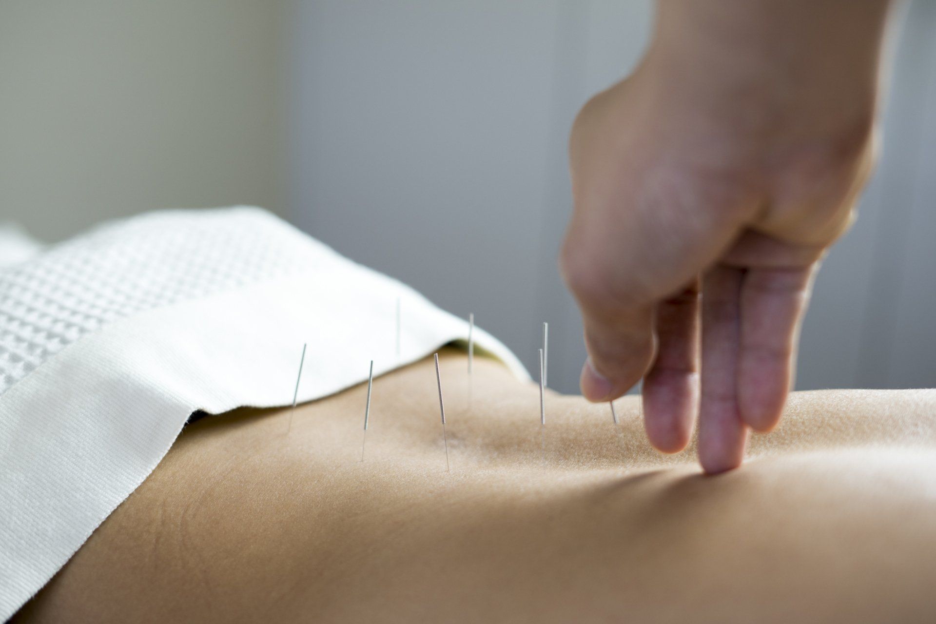 Acupuncture — Duluth, MN — Audette Chiropractic Clinic