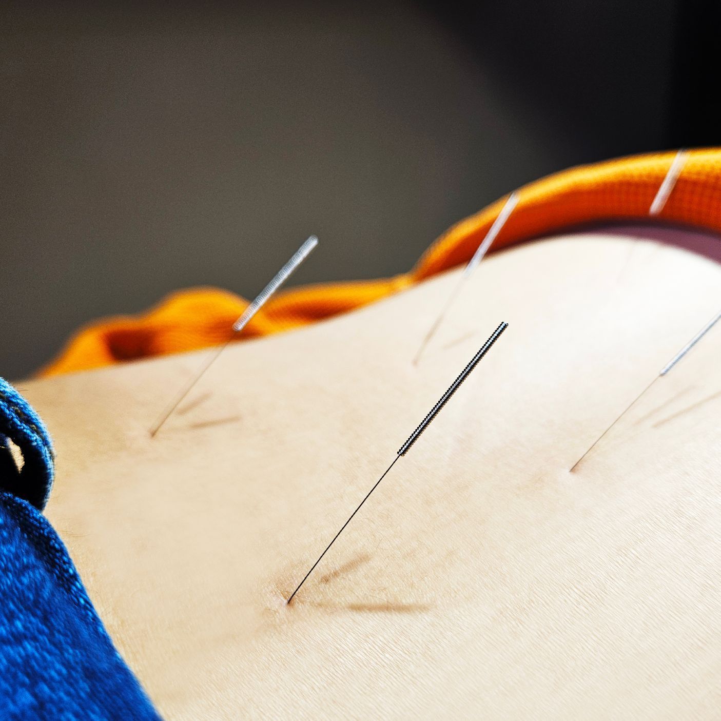 A person is getting acupuncture on their back