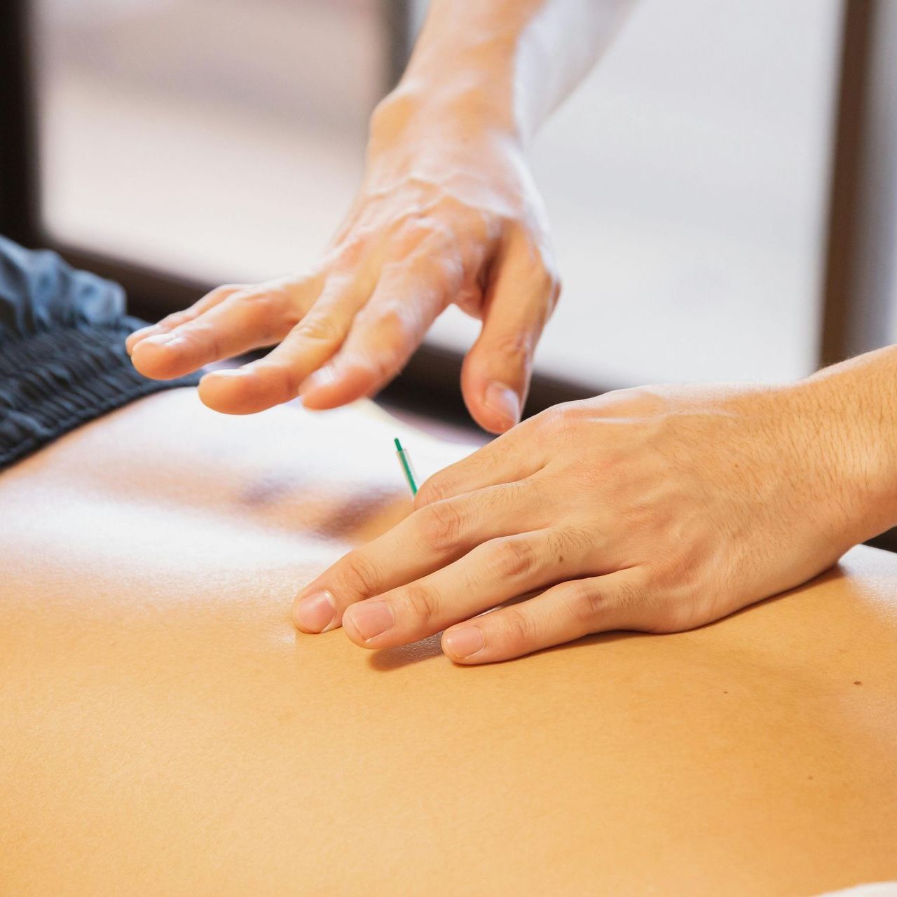 A person is getting an acupuncture treatment on their back.
