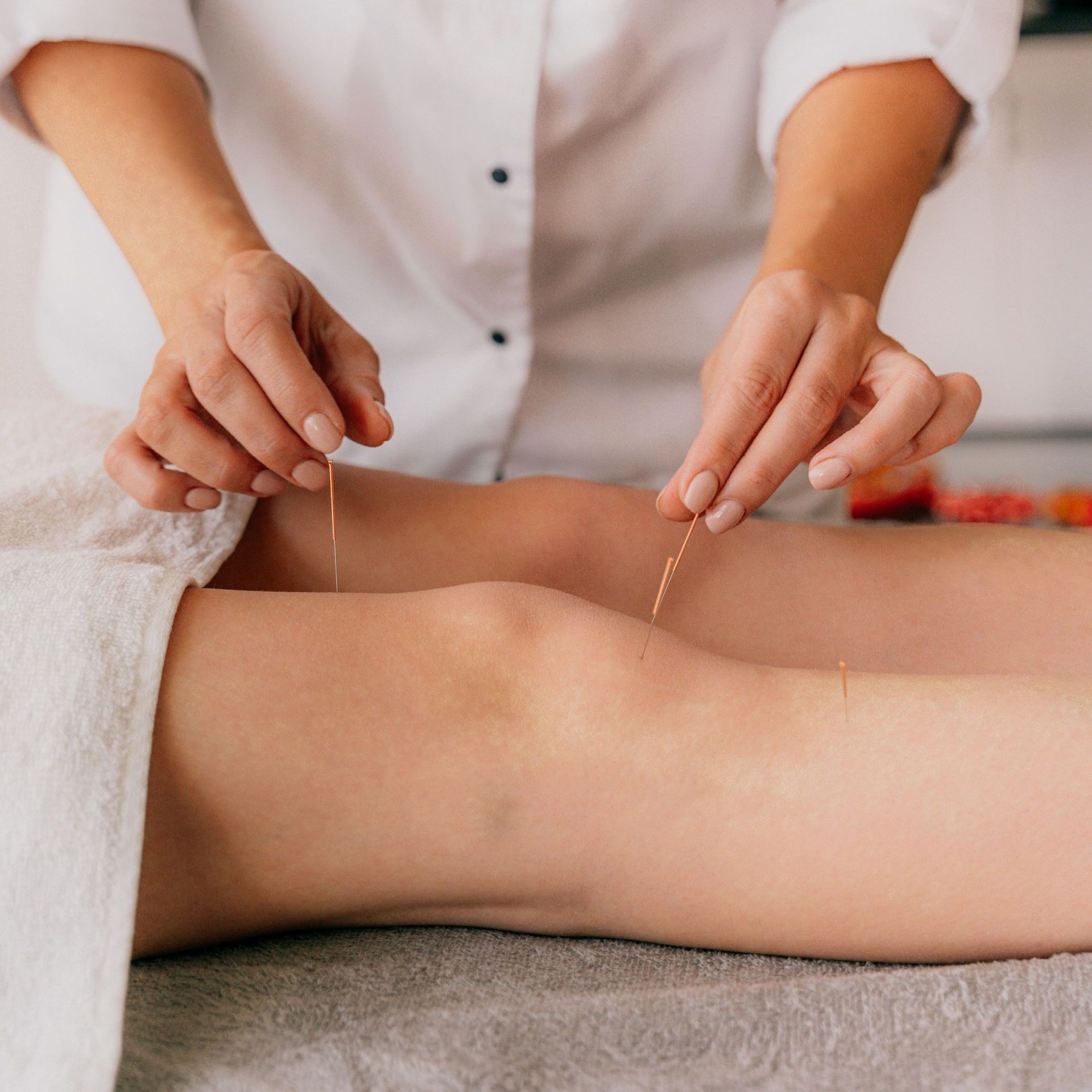 A woman is getting acupuncture on her leg.
