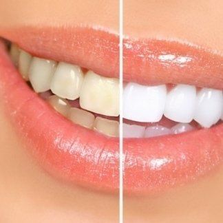 Prima e dopo trattamento sbiancante denti