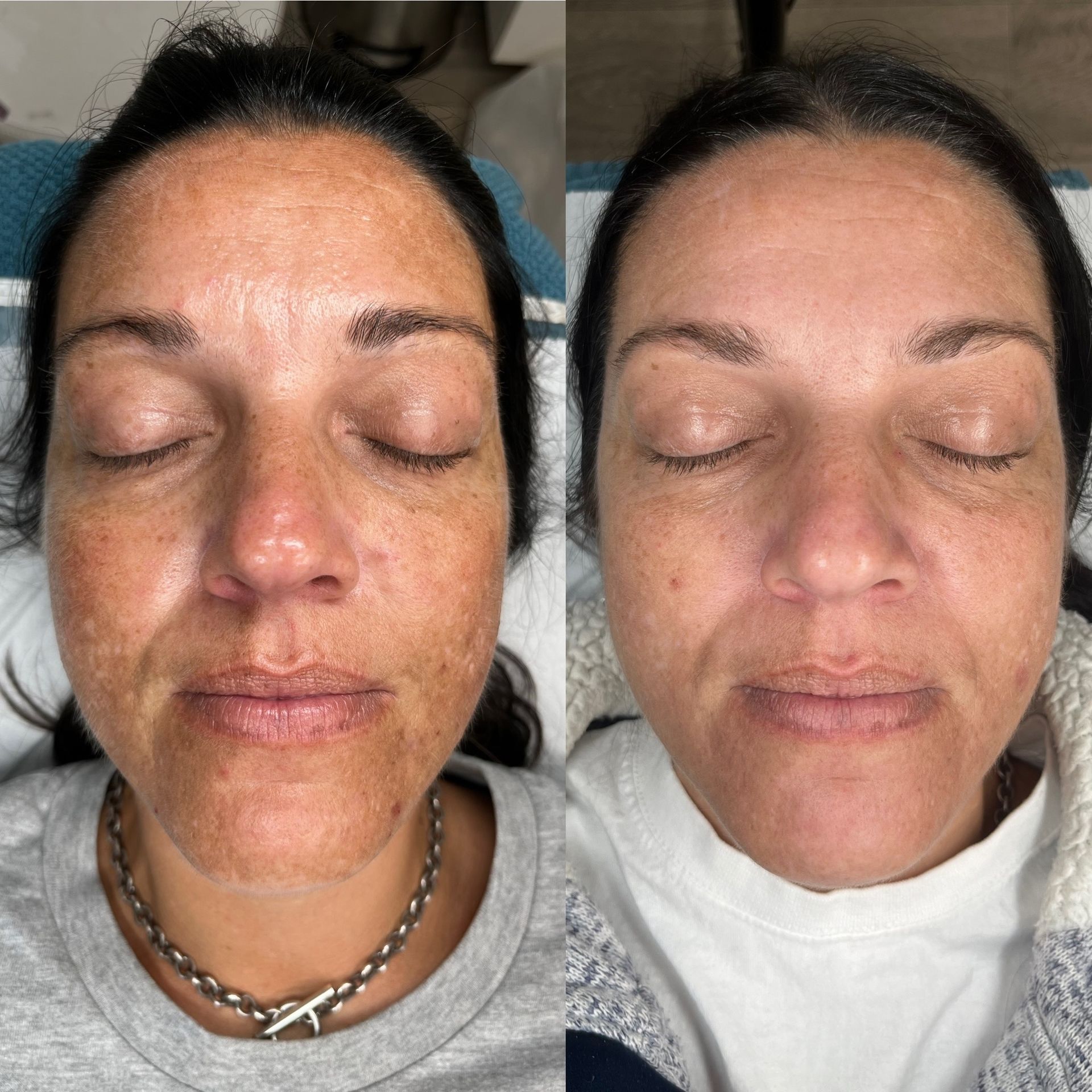 microneedling