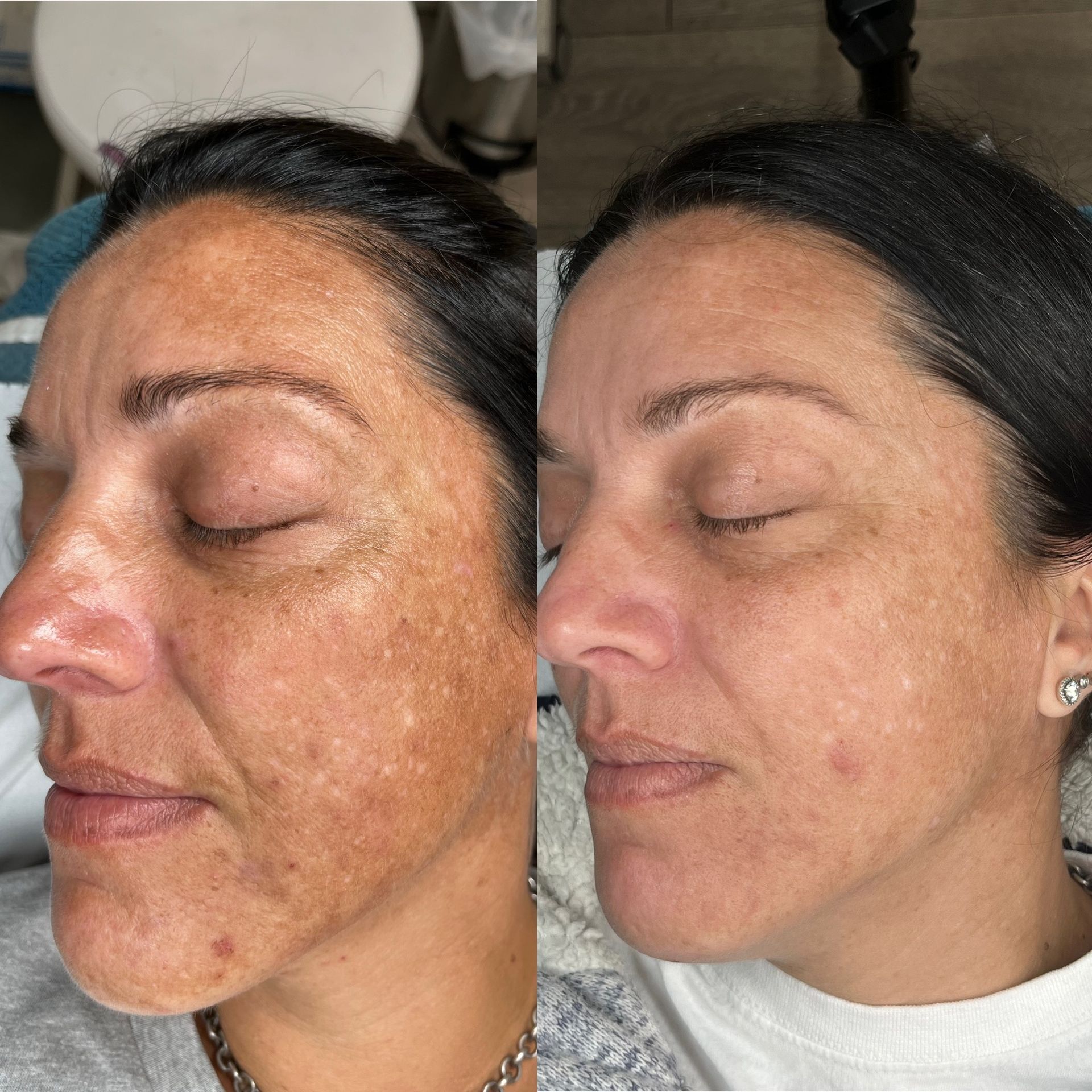microneedling