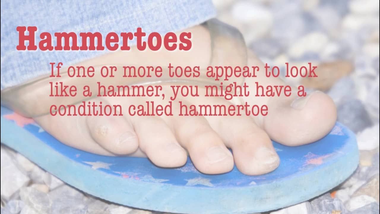 Hammertoes