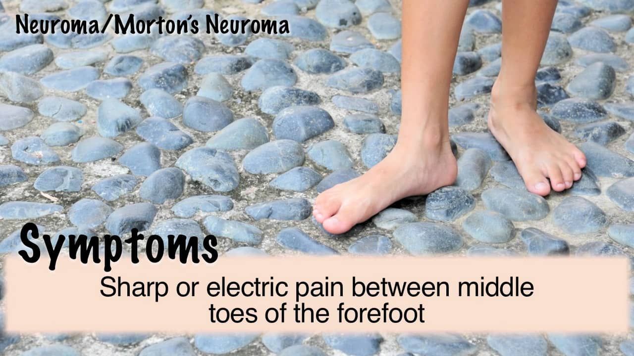 Neuroma