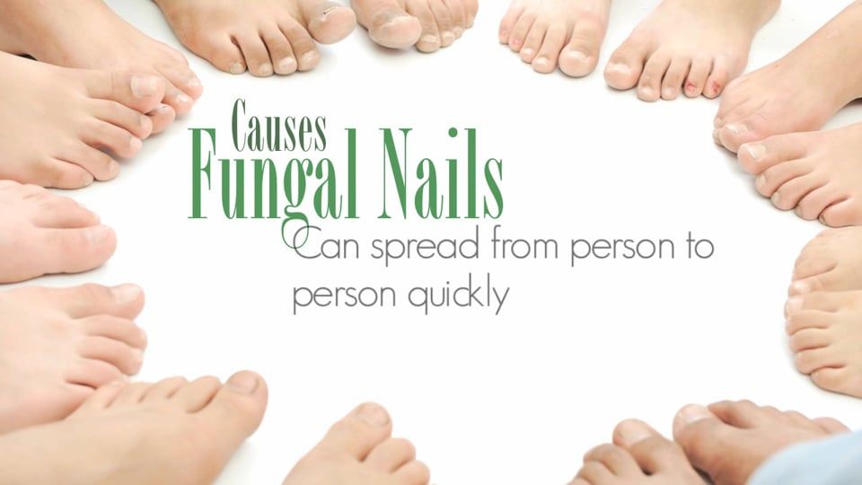 Fungal Nail