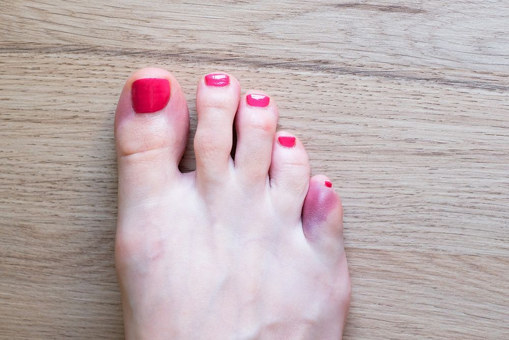 Broken Toes