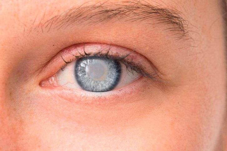 DRA. BLANCA CAROLINA FIERRO AYÓN - ENFERMEDADES DE LOS OJOS