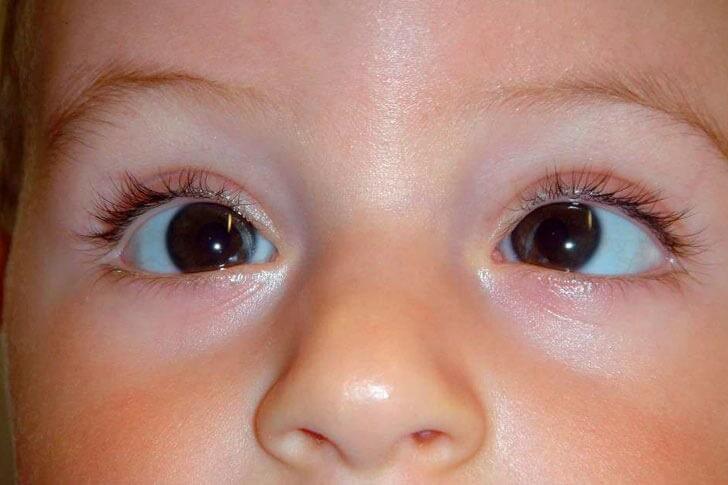 DRA. BLANCA CAROLINA FIERRO AYÓN - ESTRABISMO