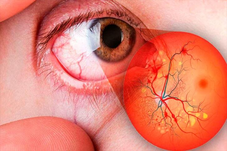 DRA. BLANCA CAROLINA FIERRO AYÓN - RETINOPATIA
