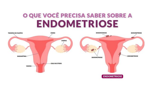Utero Da Mulher Qual O Tamanho Normal Do útero? Tua Saúde