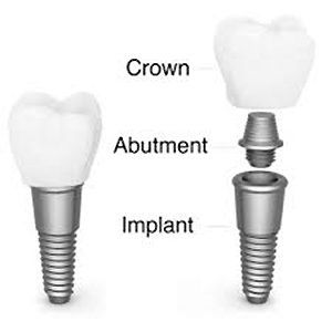 structure of a tooth implant