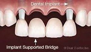implant supported bridge