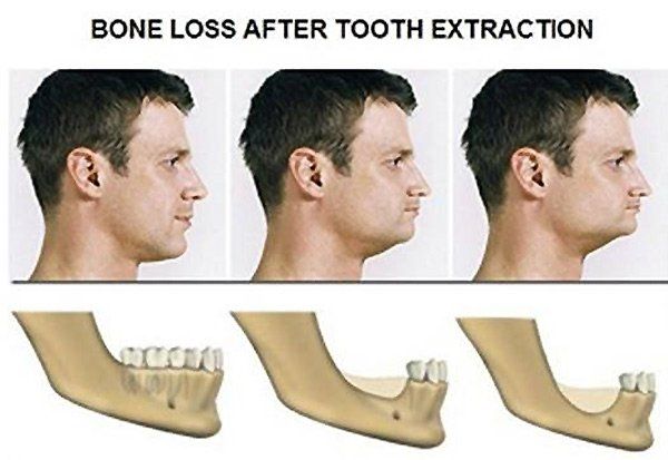Bone Loss after Tooth Extraction
