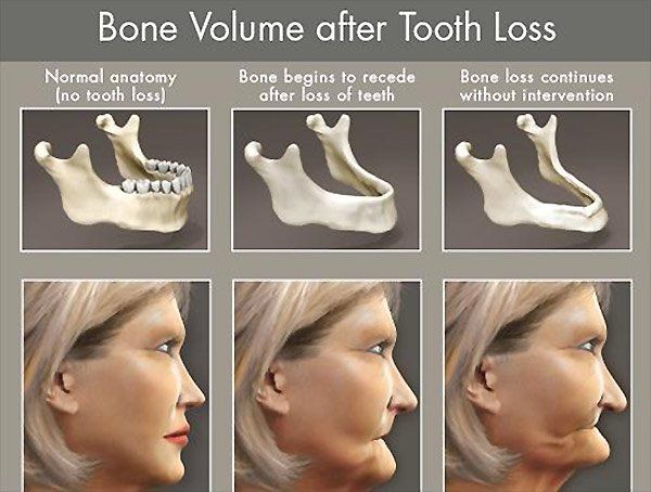 Bone Volume after Tooth Loss