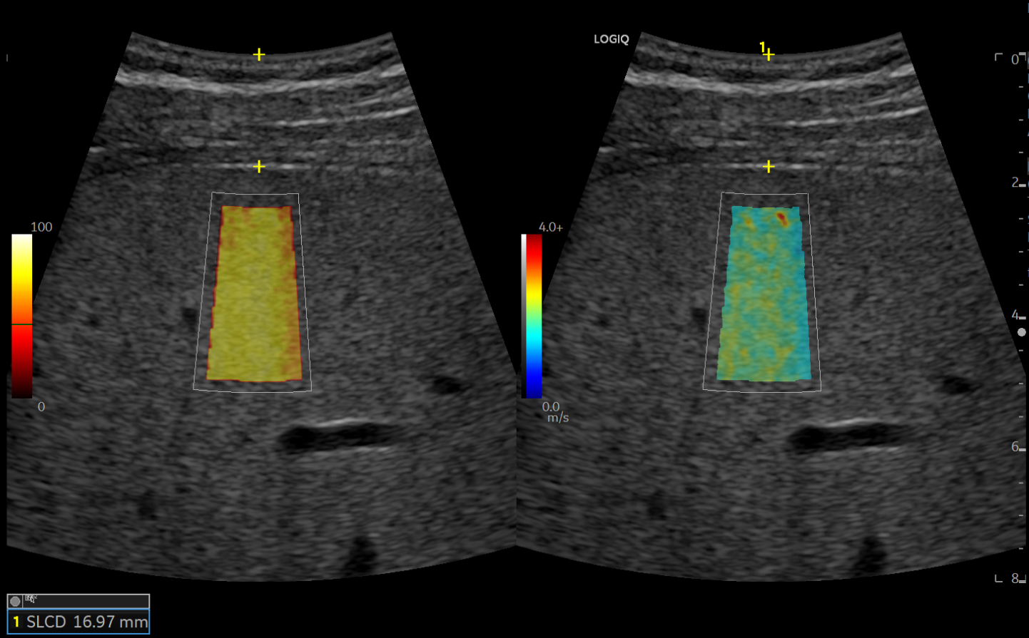 A couple of ultrasound images of a liver with a yellow square in the middle.