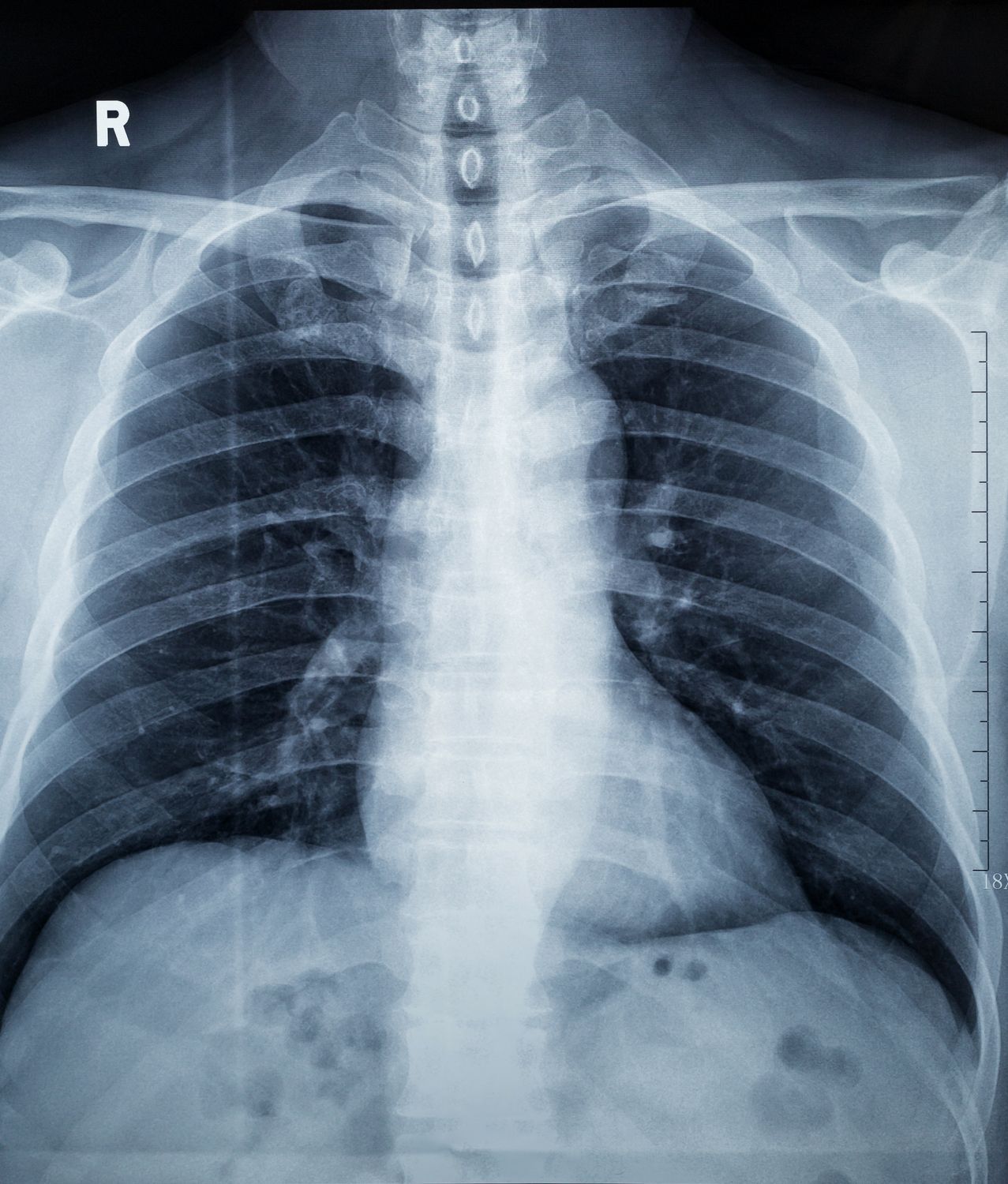 A black and white ct scan of a person 's lungs.
