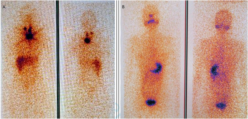 A series of four images of a person 's body showing different stages of cancer.
