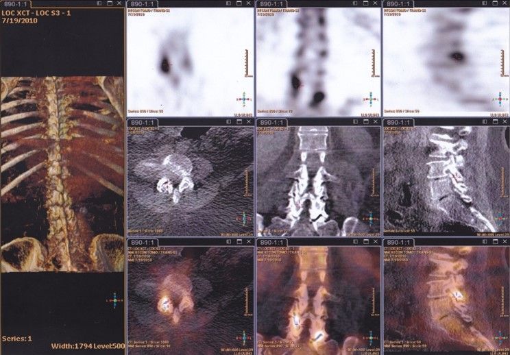 A ct scan of a person 's spine is shown