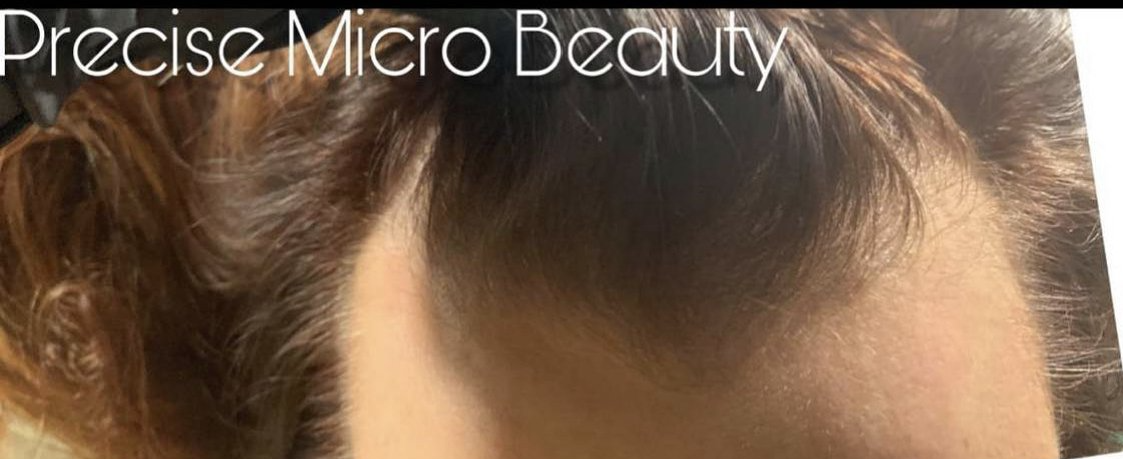 Cryoskin and scalp micro pigmentation