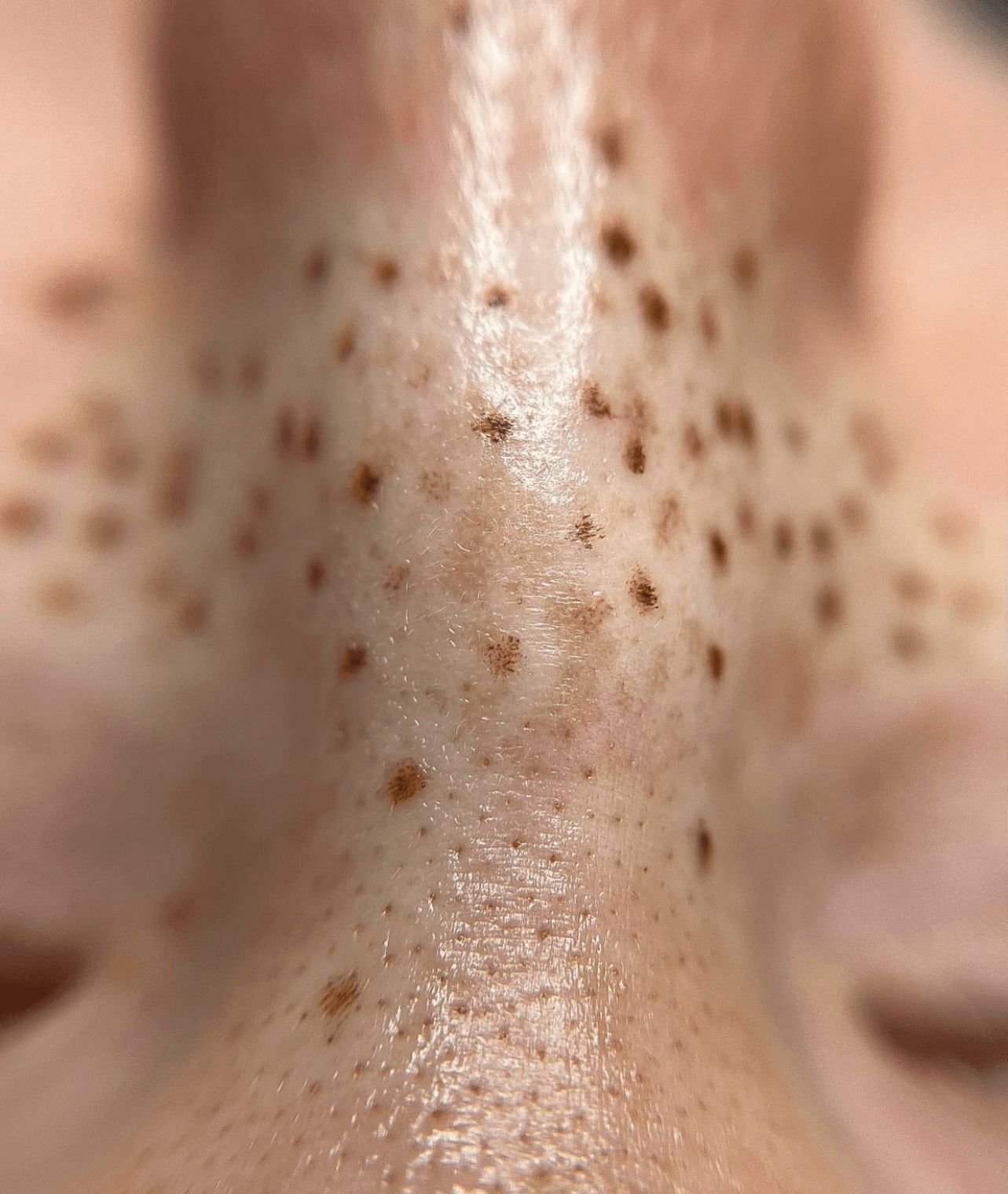 Faux Freckles treatment