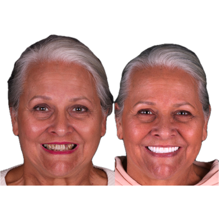 Two side-by-side images of a woman: before and after dental work. The after image shows a bright white smile.
