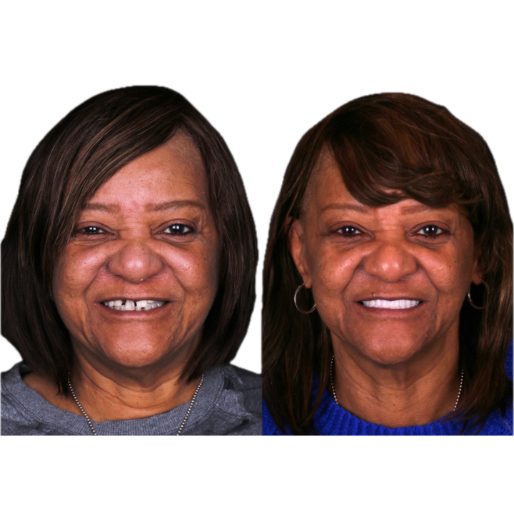 Side-by-side photos of a woman. Left shows uneven teeth, right displays improved smile. Both show dark hair, a blue sweater.