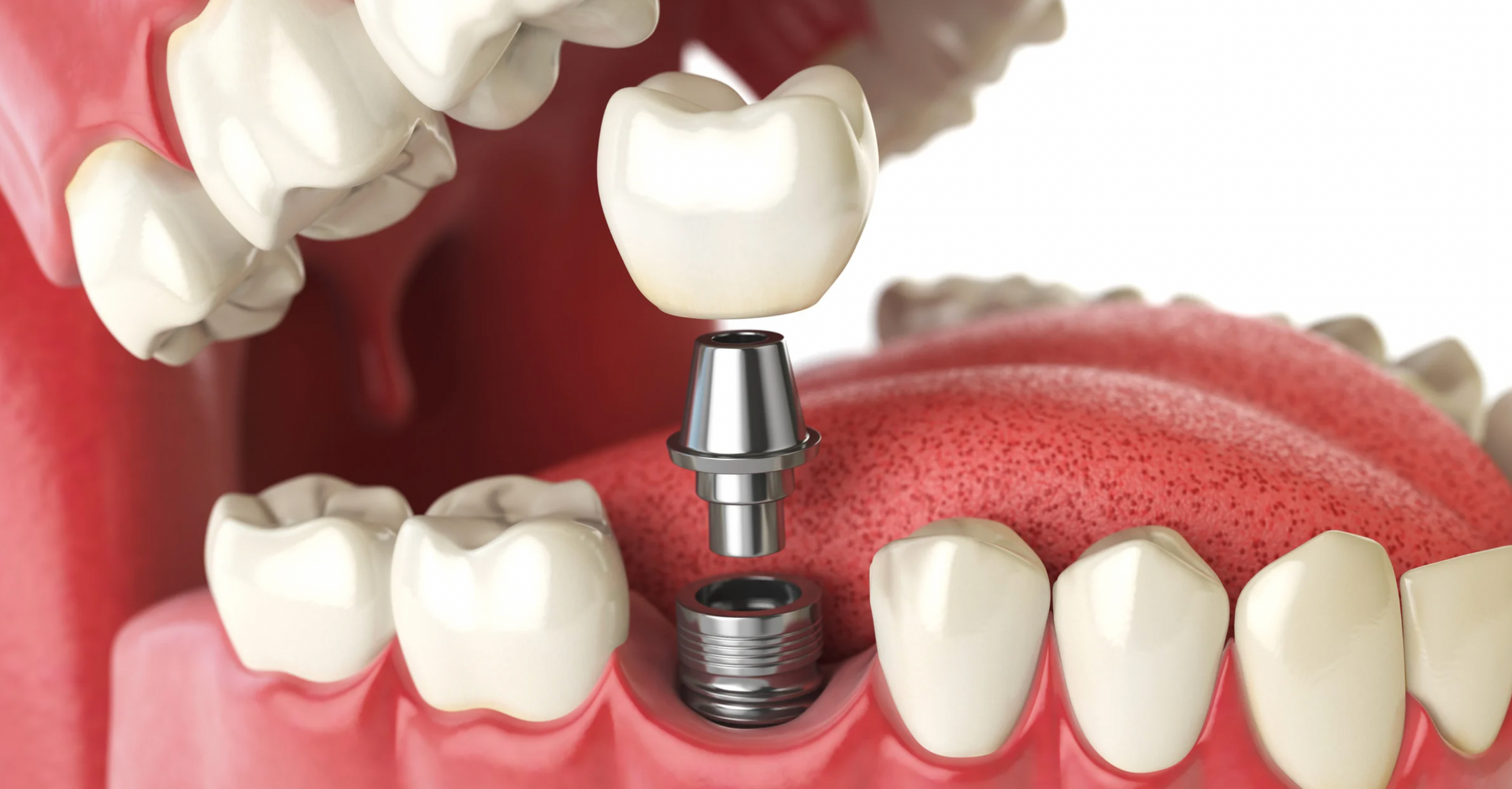 How Dental Implants Prevent Bone Loss and Improve Jawbone Health