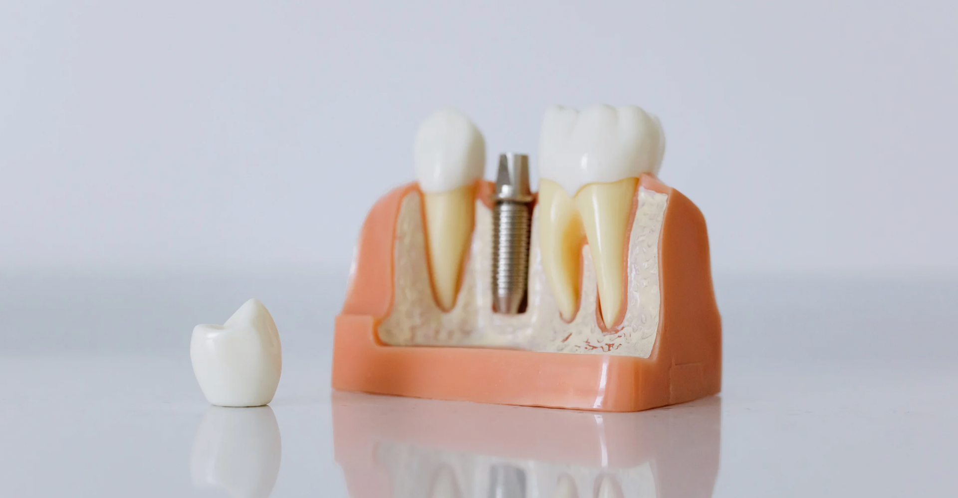 Understanding All-on-4: A Permanent Solution for Missing Teeth