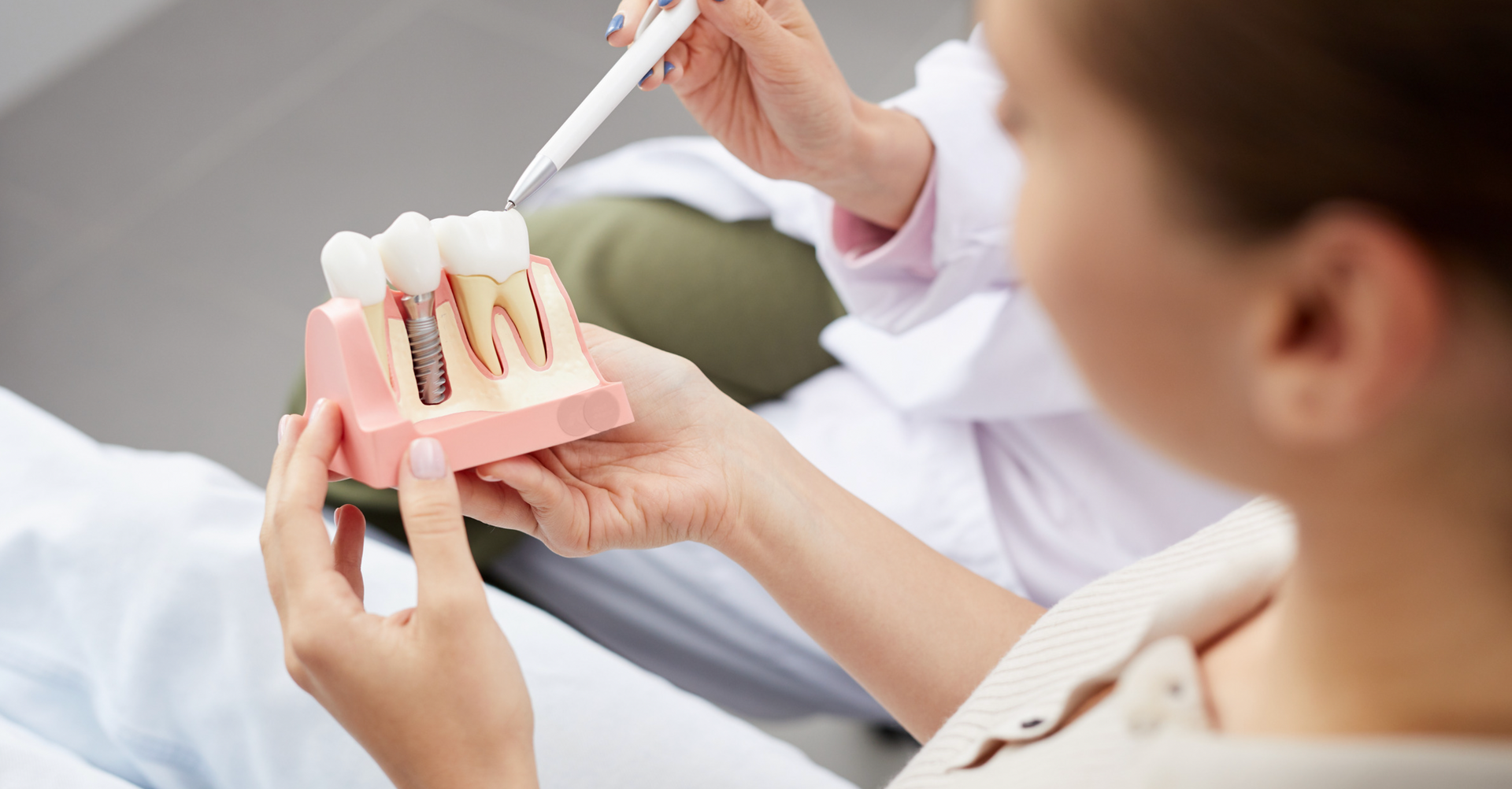 All-on-4, 5, 6, or X Dental Implants: What Do They Mean?