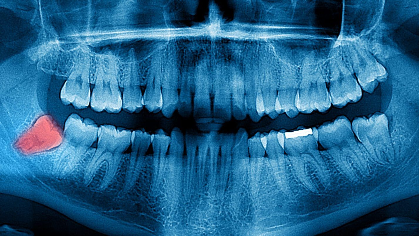 Impacted Wisdom Tooth Symptoms Causes And Treatment Modern Day Smiles