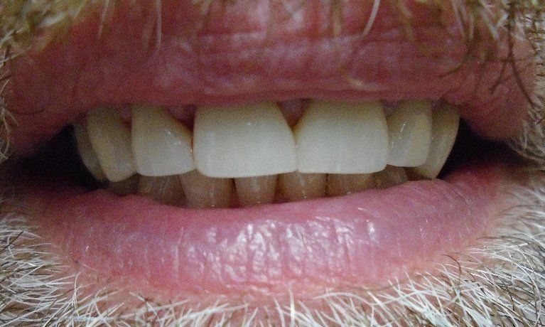 Gapped teeth after