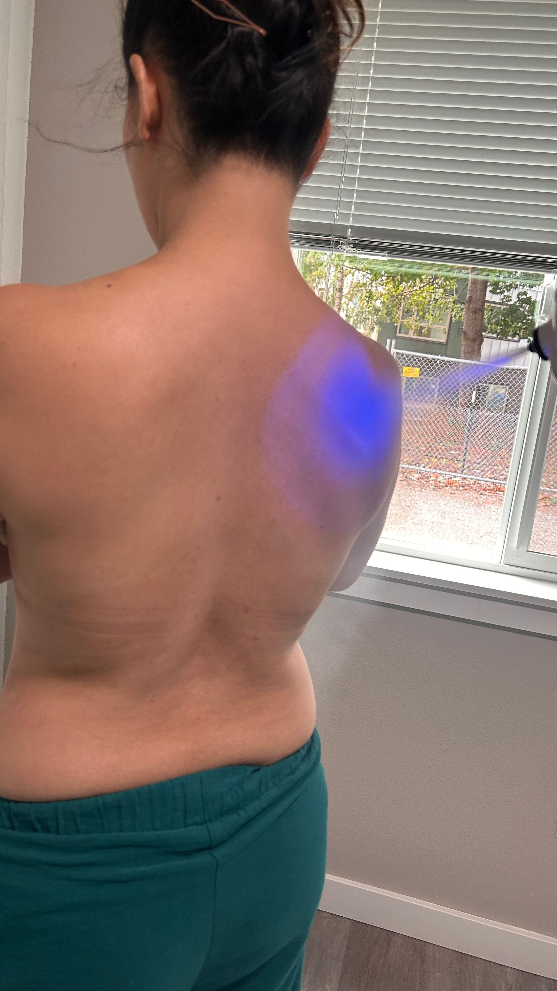 cryotherapy on back 